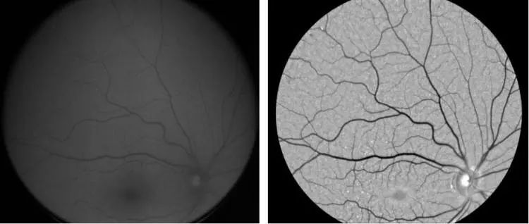 用AI检测阿尔兹海默病,能提前20年判断患病可能